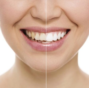 Teeth-Whitening-half-white-smile-500px