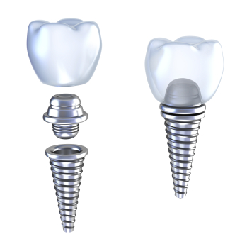 Dental-implant-diagram-being-attached-together